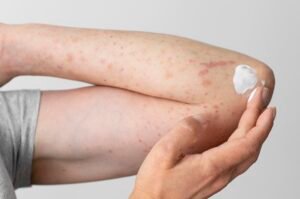 Bedbug Bites